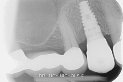 Dental Implants