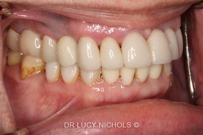 Dental Implants